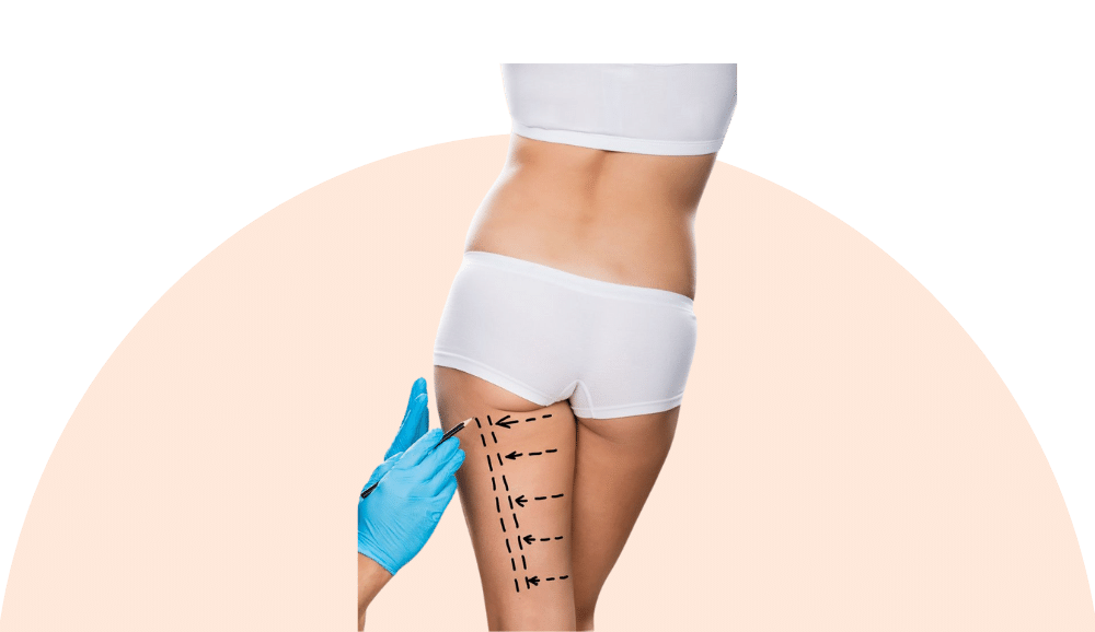 Liposuction