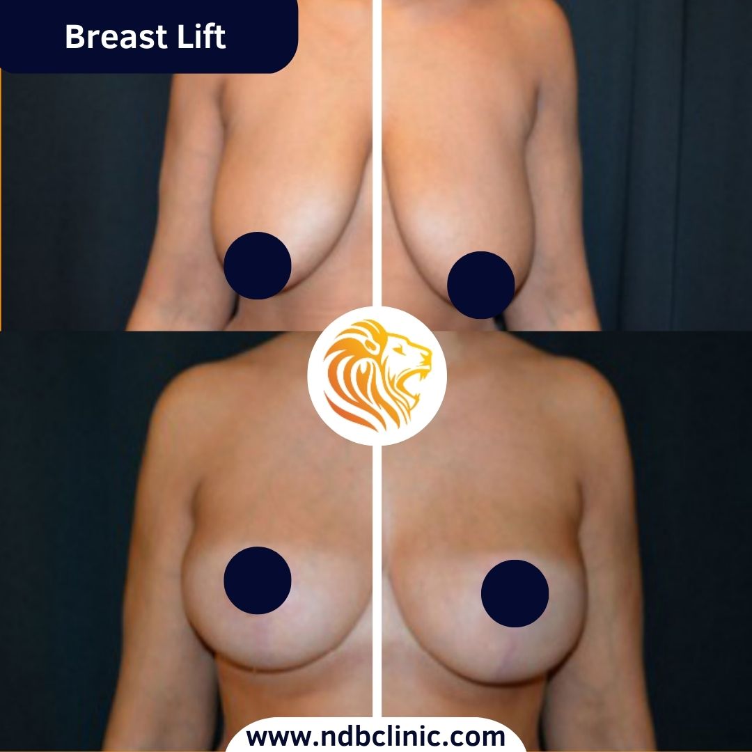 Breast Lift